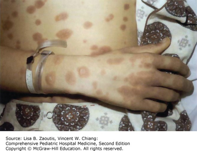 Fever and Rash Diagnosis