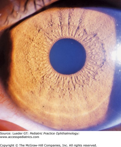Iris and Pupil Disorder Diagnosis