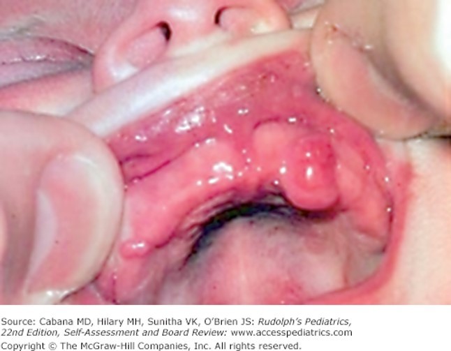 Oral Cavity Disorders Case