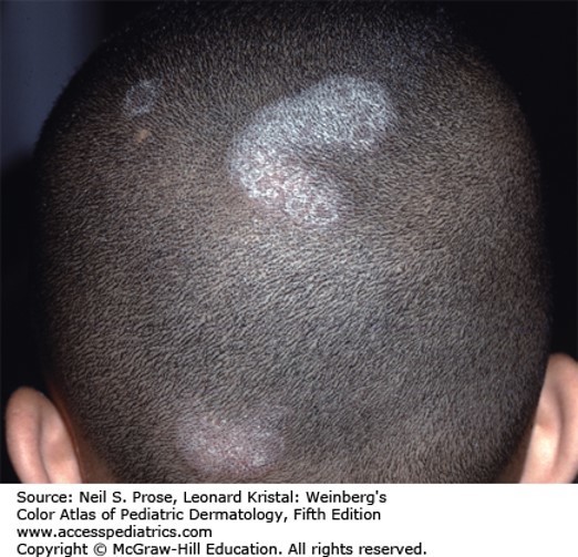 Papulosquamous Diseases Diagnosis