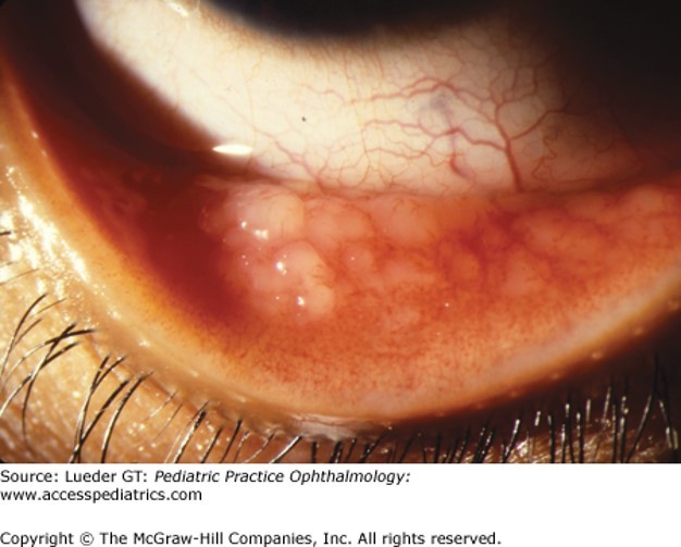 Eye Disorders Case