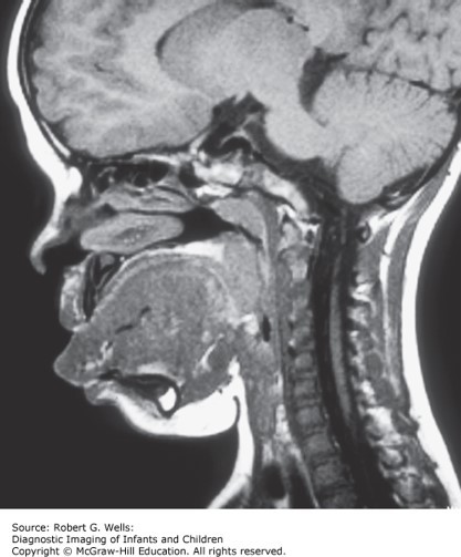 Clinical Genetics and Dysmorphology Case