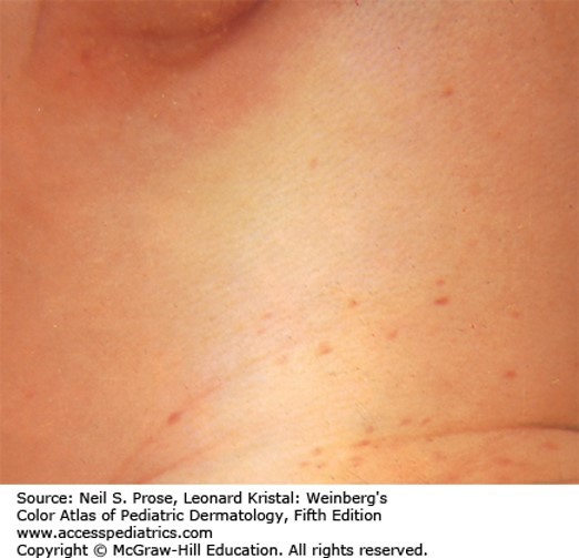 Blood Disorders Case