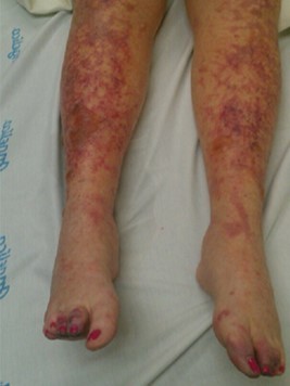 Vasculitic Neuropathies Diagnosis