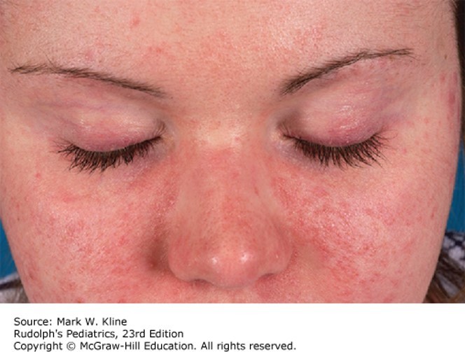 Autoimmune Diseases Diagnosis