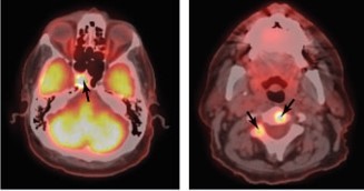Cranial Nerve Disorder Diagnosis