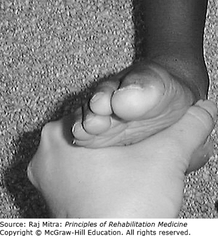 Weight Bearing Disorder Diagnosis