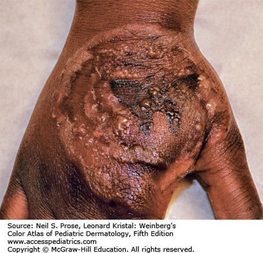 Superficial Fungal Infections Diagnosis