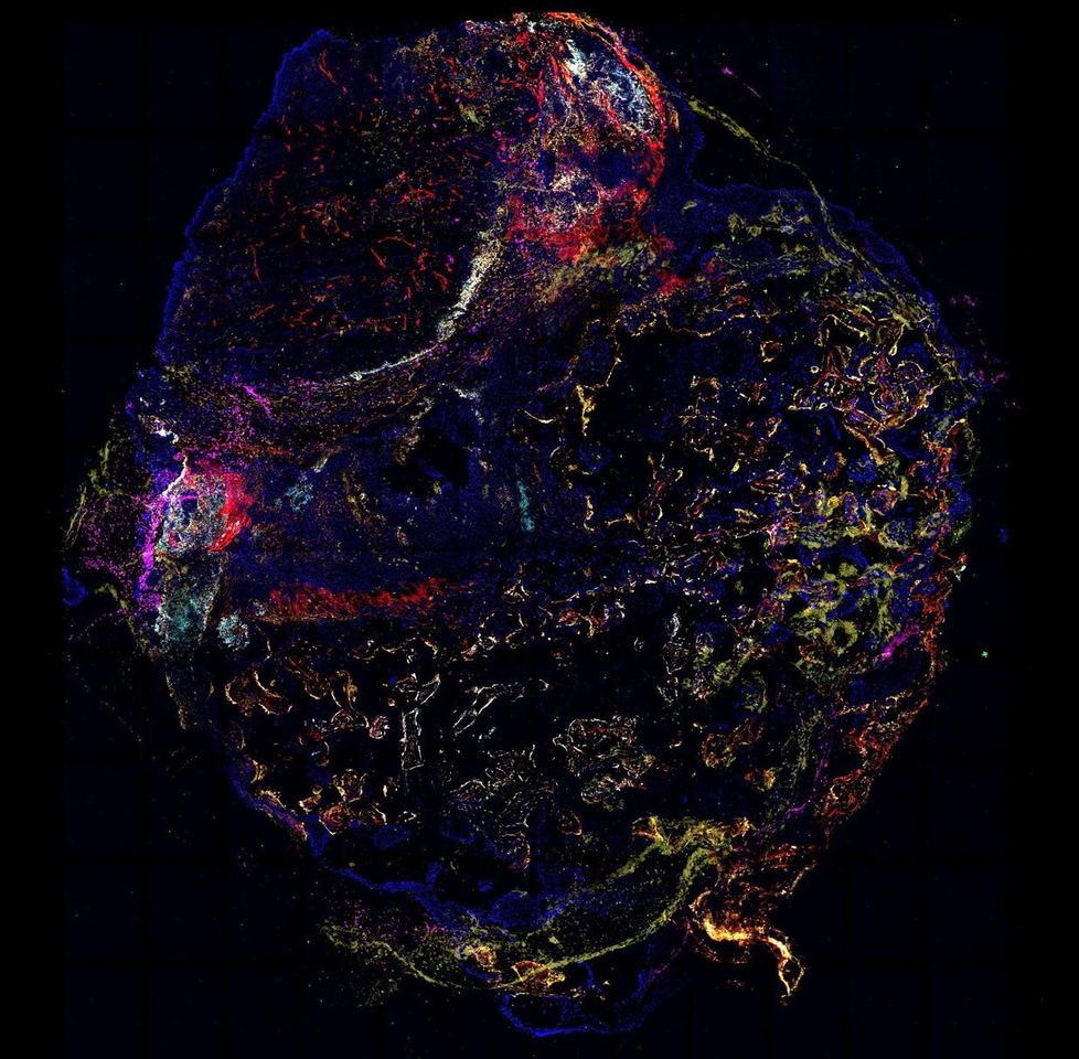 Engineered Humanized Microenvironments Expose the Awakening Tumor Niche