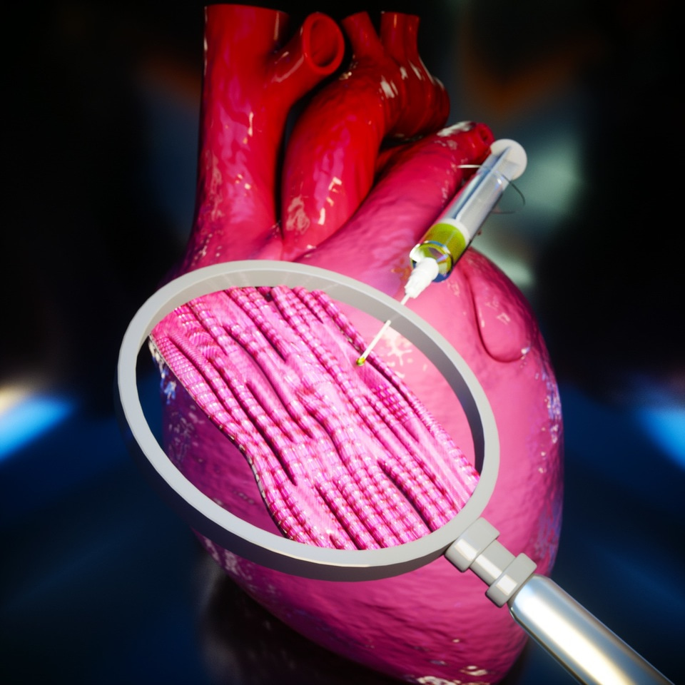 An injectable gel that restores cardiac function after heart attack