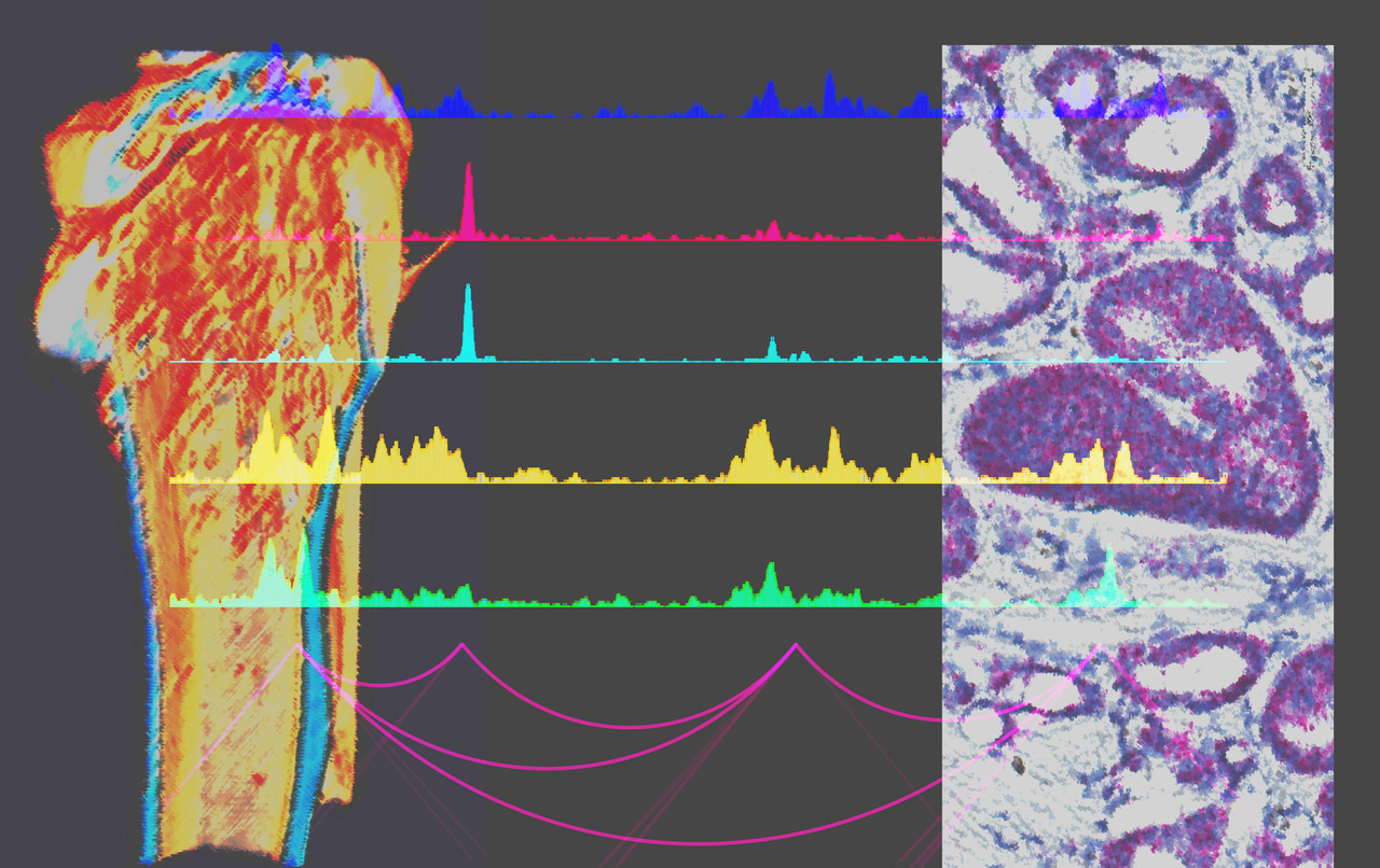 DLX1 is more than just a urinary diagnostic biomarker for prostate cancer 