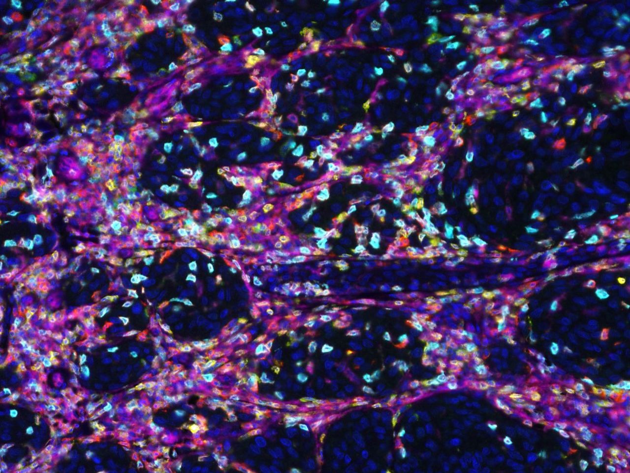 Studying the T cell repertoire and risk of melanoma progression