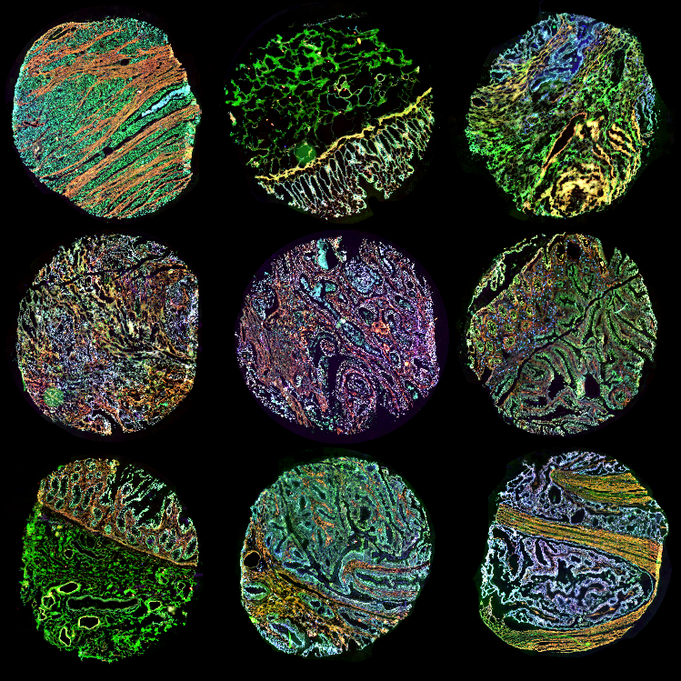 Engineering a sensitive nanosensor for cancer