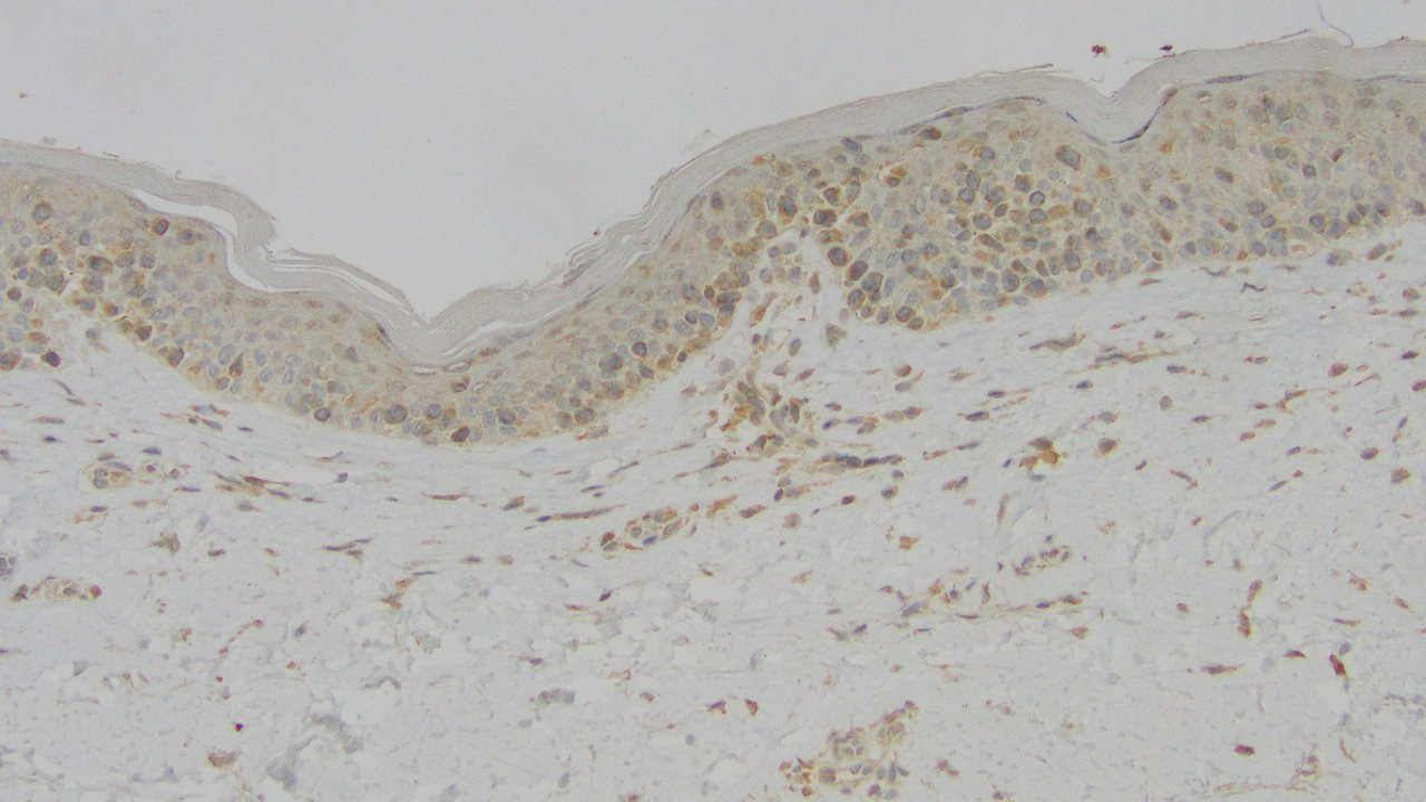 Decoding Cutaneous Gamma Delta T Cell Lymphomas
