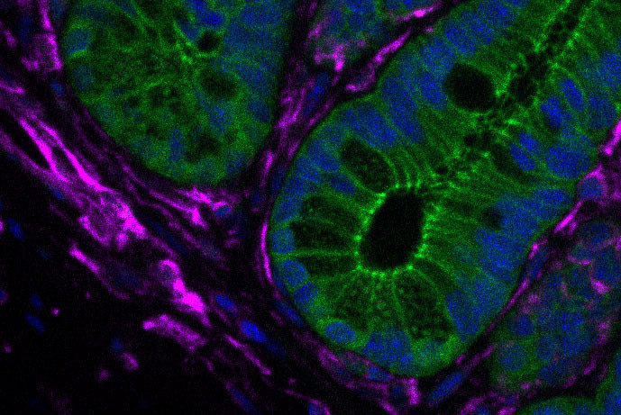 Fibroblasts drive gut tumorigenesis