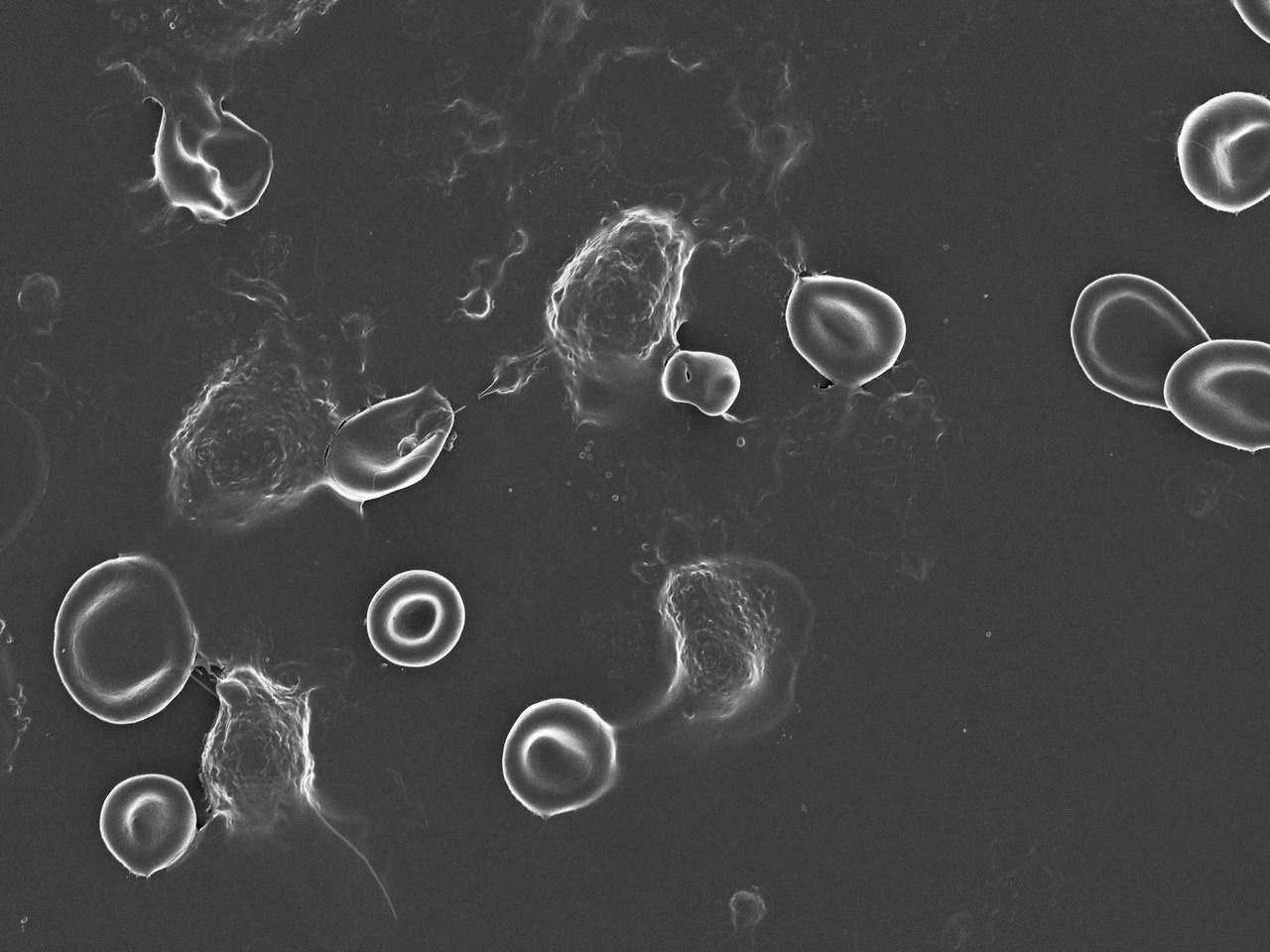Colorectal cancer is associated with increased circulating lipopolysaccharide, inflammation and hypercoagulability