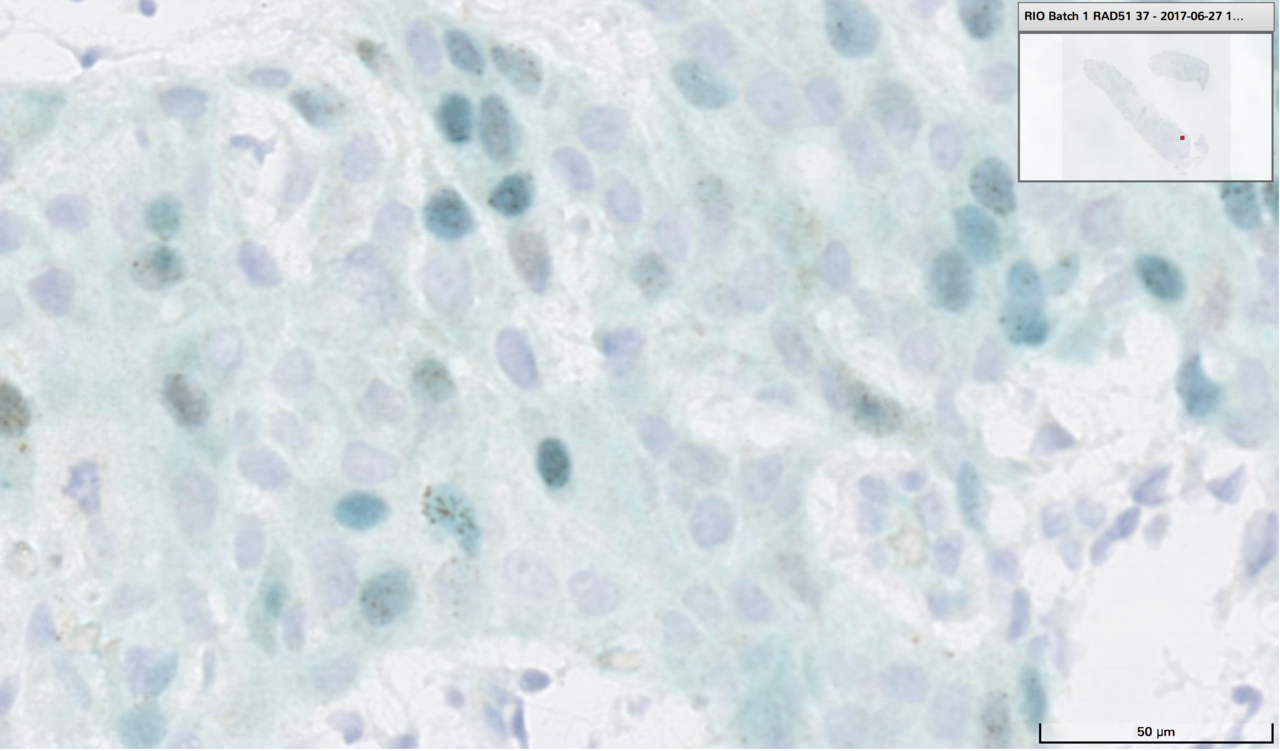 Homologous recombination DNA repair deficiency and PARP inhibition activity in primary triple negative breast cancer