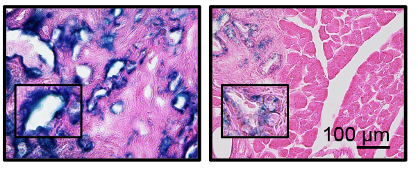 Senolytic Therapy of PDAC