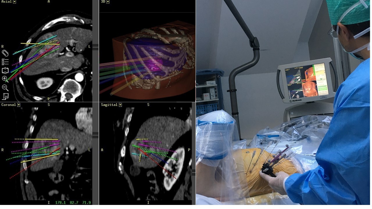 Quality of life analysis after stereotactic radiofrequency ablation of liver tumors 