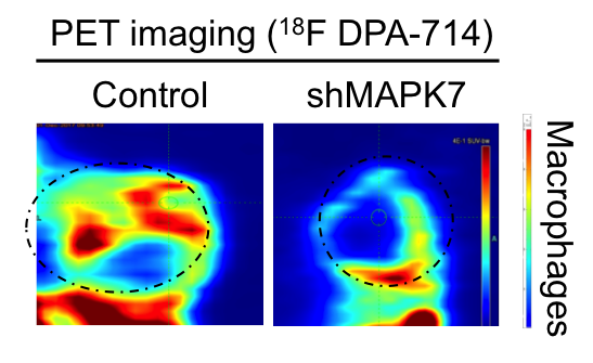 Advancement in primary bone cancer: MAPK7-MMP9 is a nexus for osteosarcoma metastases