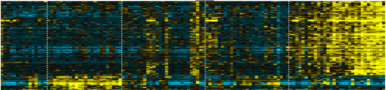 A transcriptomic continuum of differentiation arrest identifies myeloid interface acute leukemias with poor prognosis 