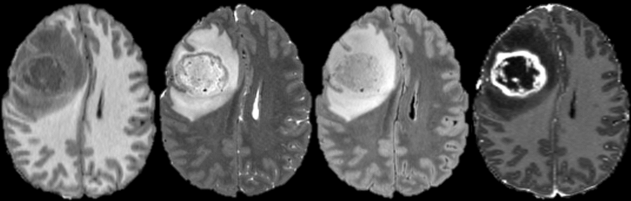 A fully automated artificial intelligence method for non-invasive, imaging-based identification of genetic alterations in glioblastomas