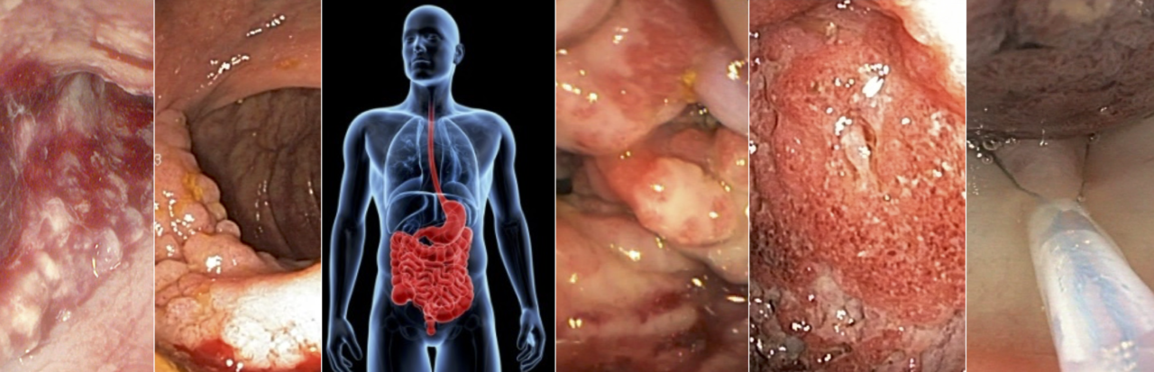 HyperKvasir: Data to enable AI for automated GI disease detection