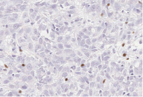 Unlocking the potential for immune checkpoint inhibitors in Metaplastic Breast Cancers.