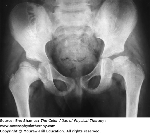 LEGG-CALVE-PERTHÉS DISEASE