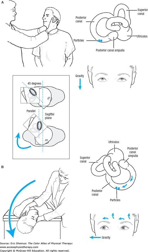 BENIGN PAROXYSMAL POSITIONAL VERTIGO