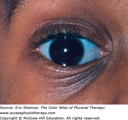 Osteogenesis Imperfecta