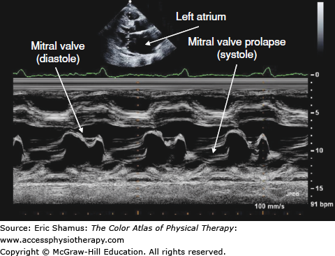 Mitral Valve Prolapse