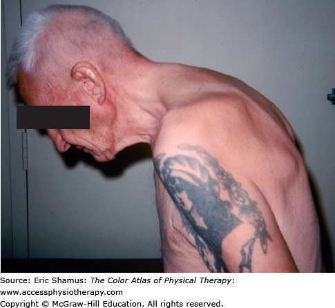 Ankylosing Spondylitis