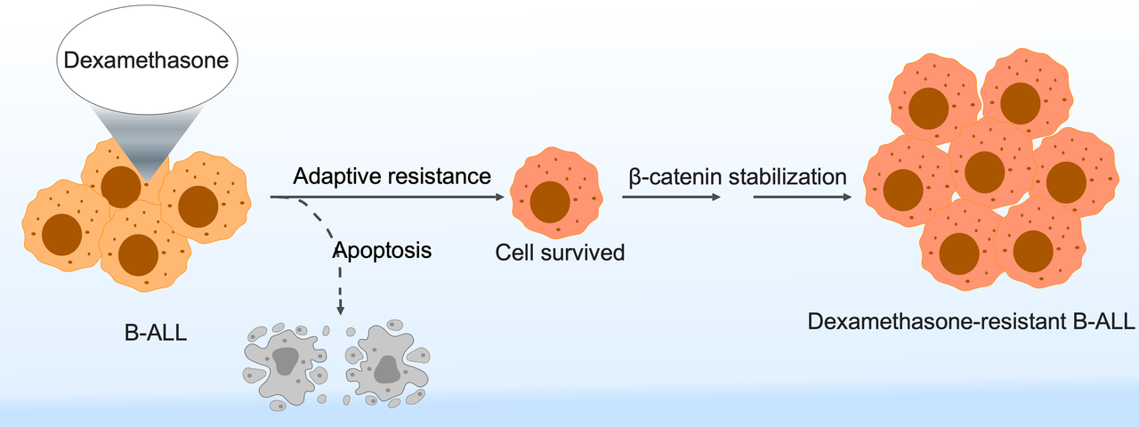 Glucocorticoid resistance in B cell acute lymphoblastic leukemia 