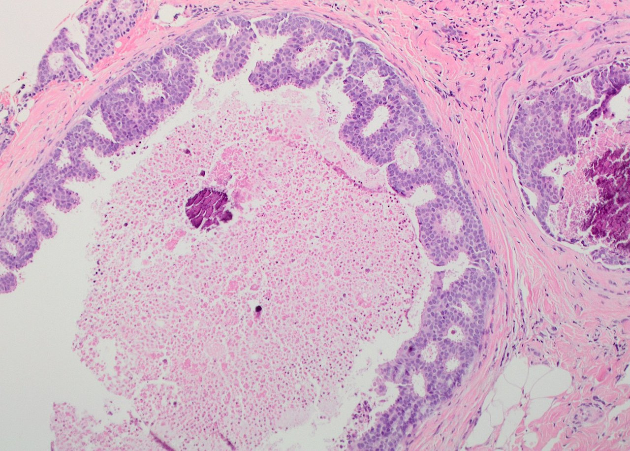 Pathological features of 11337 patients with primary ductal carcinoma in situ (DCIS) and subsequent events – results from the UK Sloane project