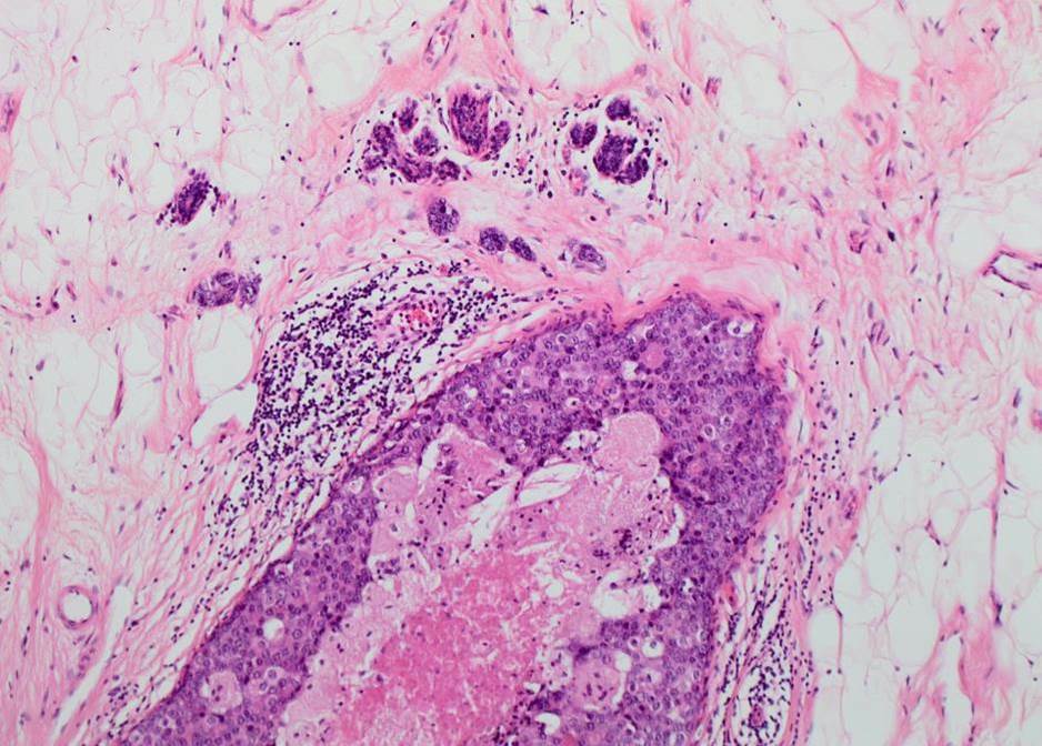 The presentation, management and outcome of patients with ductal carcinoma in situ (DCIS) with microinvasion (invasion ≤1 mm in size)—results from the UK Sloane Project