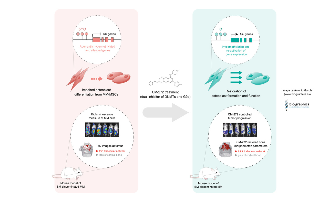 Epigenetics as a new target for treatment of bone disease in multiple myeloma