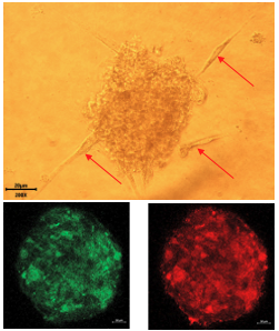 Unveiling human cytomegalovirus as a causal factor for glioblastoma. 