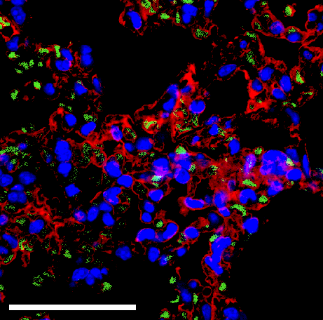 Mtb biofilms: a sticky affair to fight the war for tubercle bacilli!