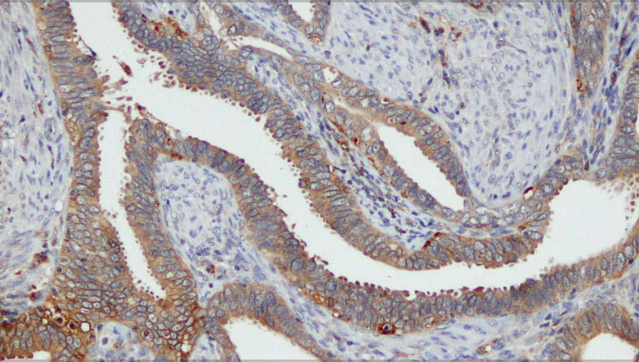 A 10-gene prognostic signature points to LIMCH1 and HLA-DQB1 as important players in aggressive cervical cancer disease