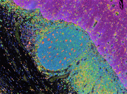 A tale of two etiologies: B cells and tertiary lymphoid structures are associated with favorable outcomes in head and neck squamous cell carcinoma
