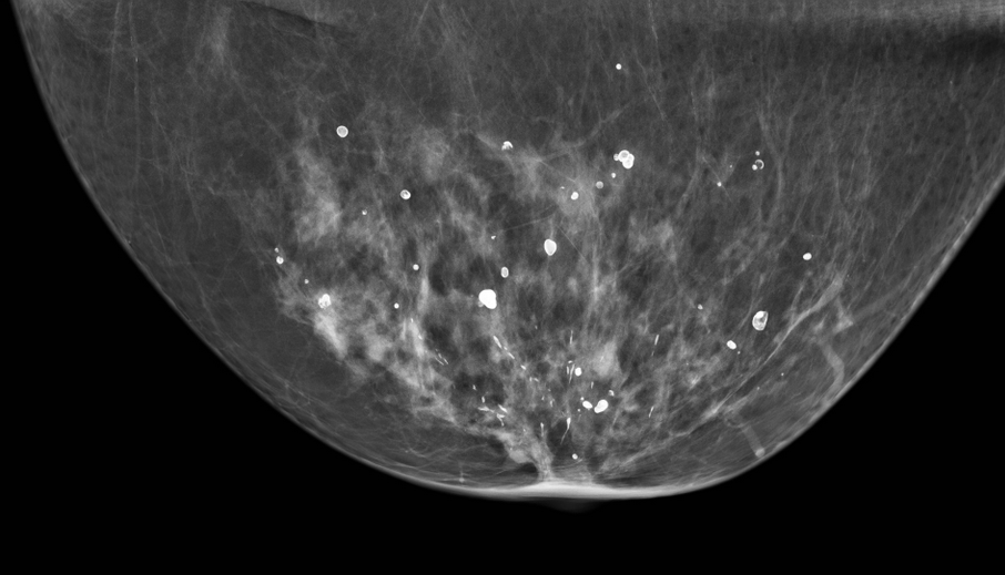 Mammographic Microcalcifications and Risk of Breast Cancer