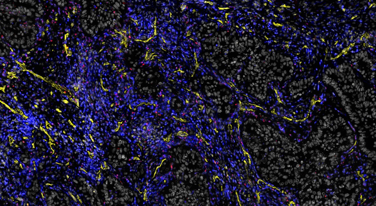Reaching for the stars: Charting the immune landscape of brain tumours through time and space
