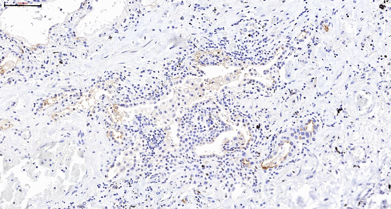 Chronic lung disease and SARS-CoV-2