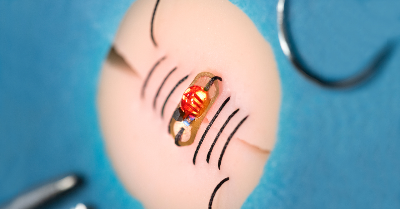 How we made smart sutures WiSe