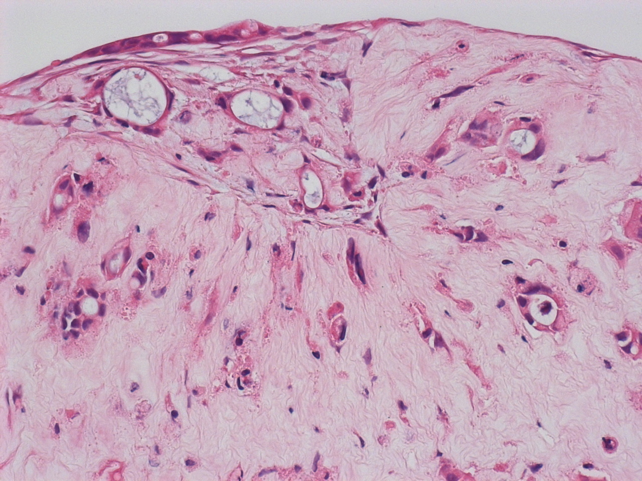 Reconstructing patient tumours to predict response