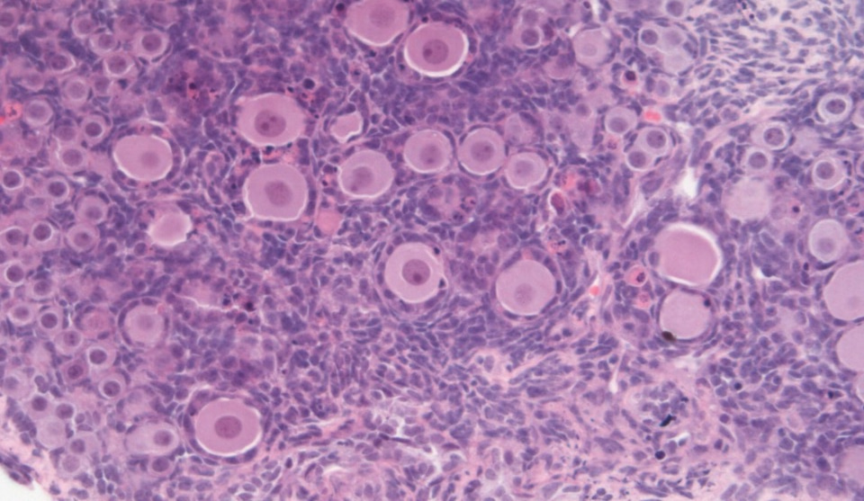 After the paper | Third generation effects of chemotherapy drug treatment?