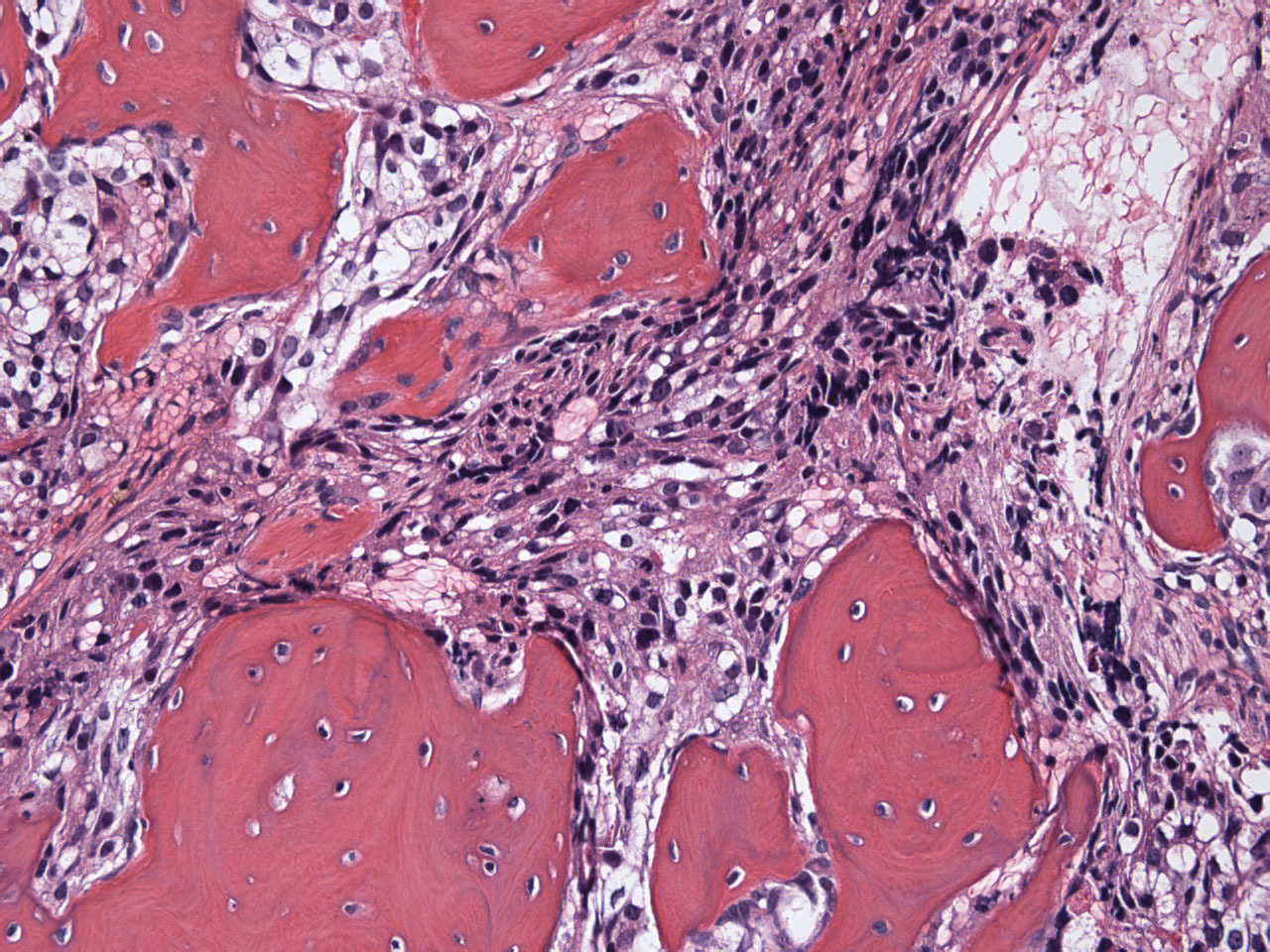 Walking the thin line of ketone body metabolism in Castrate-Resistant Prostate Cancer