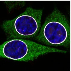 The unsuspected dark face of STING in cancer