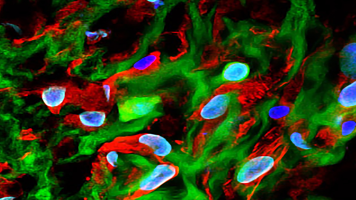 iPSC-Derived Renal Organoid Xenografts Shine a Light on Rare Human Kidney Disease Mechanisms In Vivo